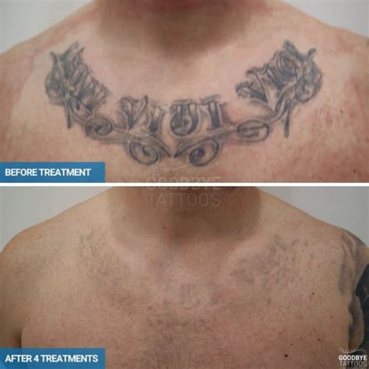 Can chest tattoos be removed?