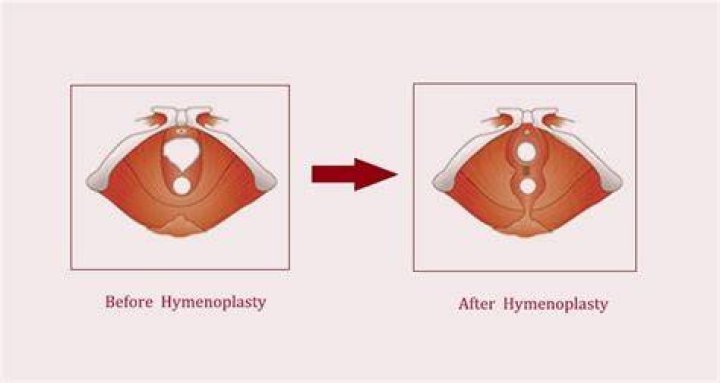 Can I walk after hymenoplasty?
