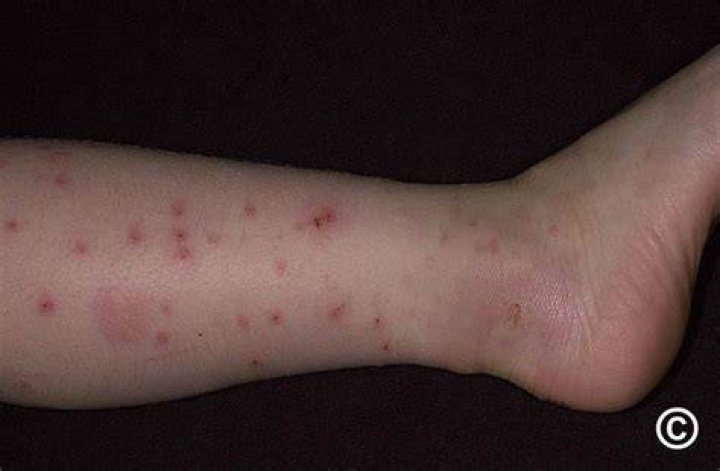 How do you get rid of papular urticaria?