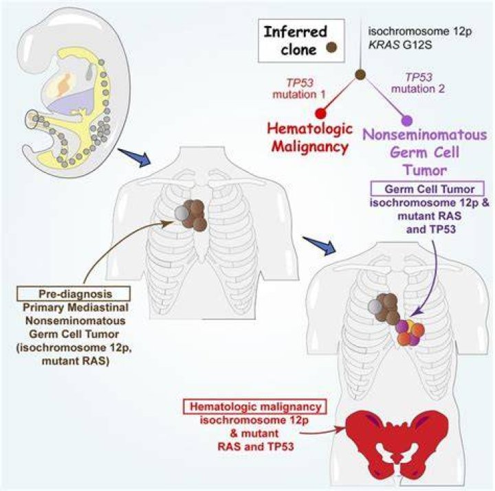 What is a Nonseminomatous germ cell tumor?