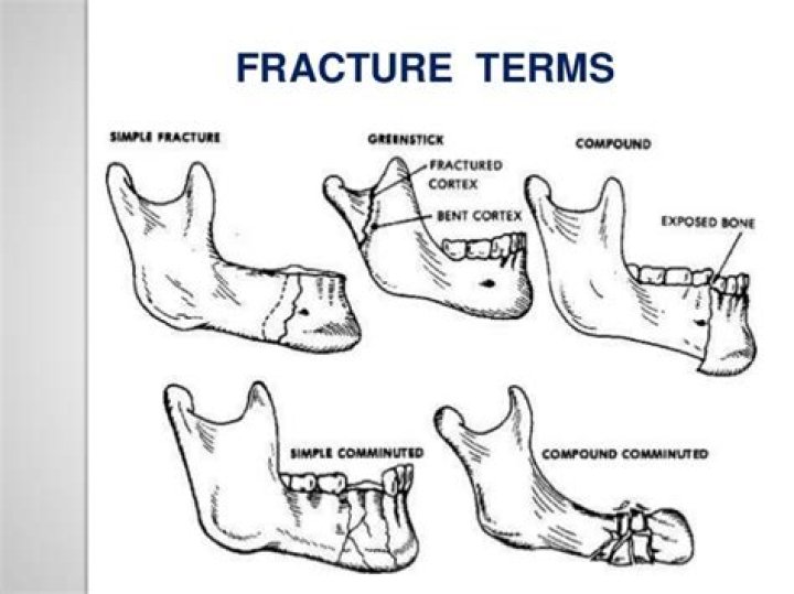 What is the most common type of mandibular fracture?